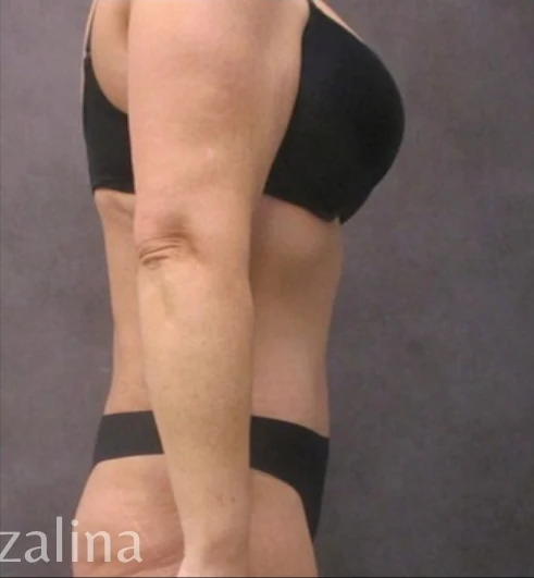 Sau: Tạo hình thành bụng (tummy tuck) & Hút mỡ 360 — nghiêng · thực hiện bởi Angelo Cuzalina, MD, DDS