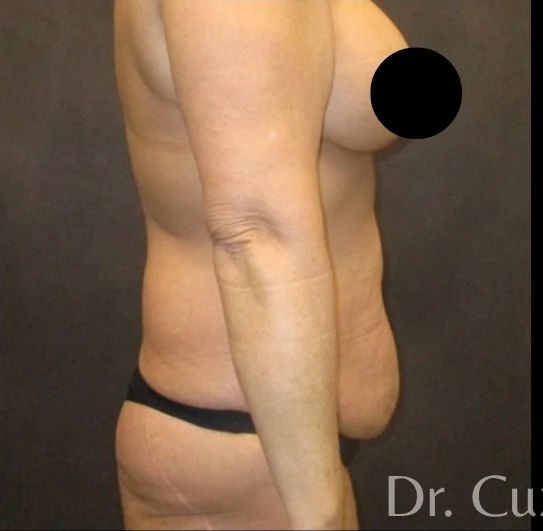 Trước: Tạo hình thành bụng (tummy tuck) & Hút mỡ 360 — nghiêng · thực hiện bởi Angelo Cuzalina, MD, DDS