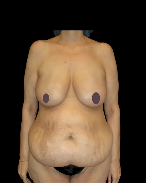 Trước: Tạo hình thành bụng (tummy tuck) — mặt trước · thực hiện bởi Chase Nelson, DO