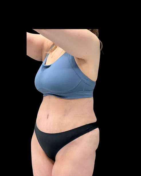 Sau: Tạo hình thành bụng (tummy tuck) — nghiêng ba phần tư trái · thực hiện bởi Chase Nelson, DO