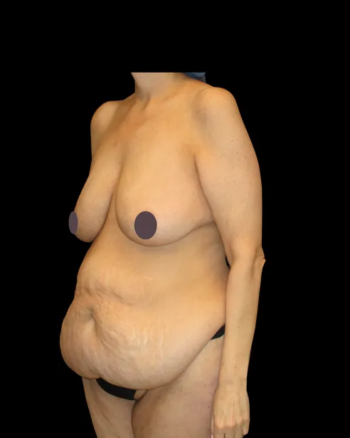Trước: Tạo hình thành bụng (tummy tuck) — nghiêng ba phần tư trái · thực hiện bởi Chase Nelson, DO