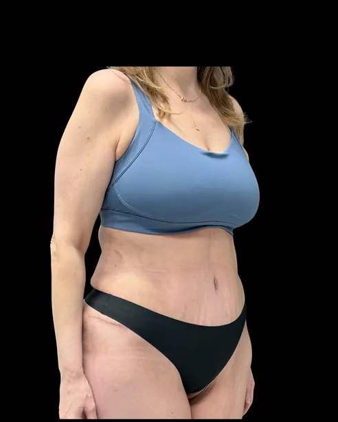 Sau: Tạo hình thành bụng (tummy tuck) — nghiêng ba phần tư phải · thực hiện bởi Chase Nelson, DO