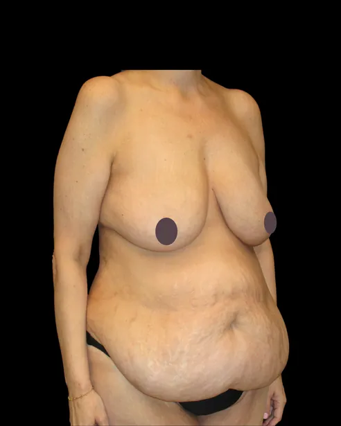 Trước: Tạo hình thành bụng (tummy tuck) — nghiêng ba phần tư phải · thực hiện bởi Chase Nelson, DO