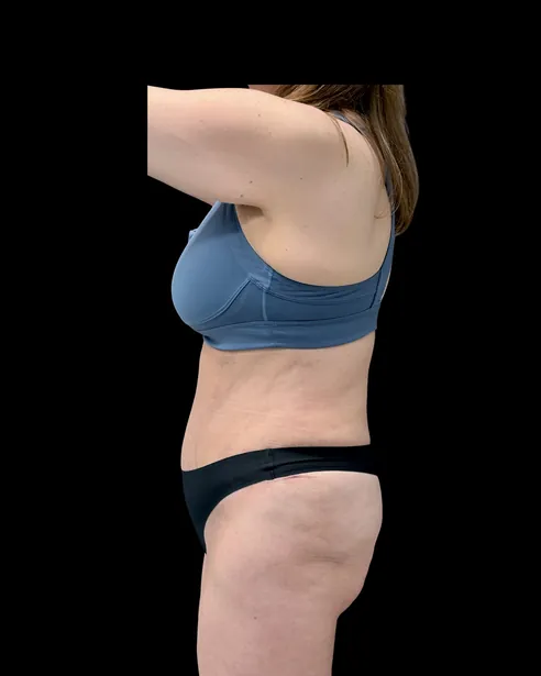 Sau: Tạo hình thành bụng (tummy tuck) — nghiêng trái · thực hiện bởi Chase Nelson, DO