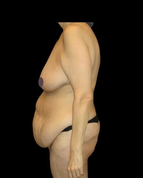 Trước: Tạo hình thành bụng (tummy tuck) — nghiêng trái · thực hiện bởi Chase Nelson, DO