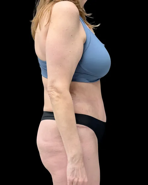 Sau: Tạo hình thành bụng (tummy tuck) — nghiêng phải · thực hiện bởi Chase Nelson, DO