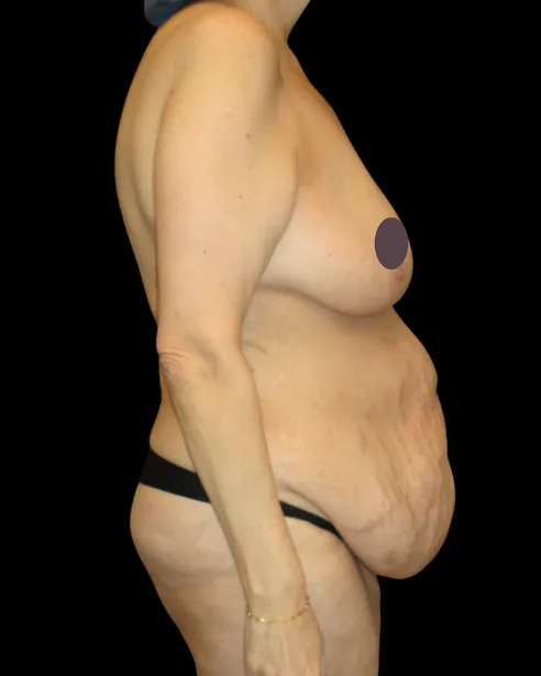 Trước: Tạo hình thành bụng (tummy tuck) — nghiêng phải · thực hiện bởi Chase Nelson, DO