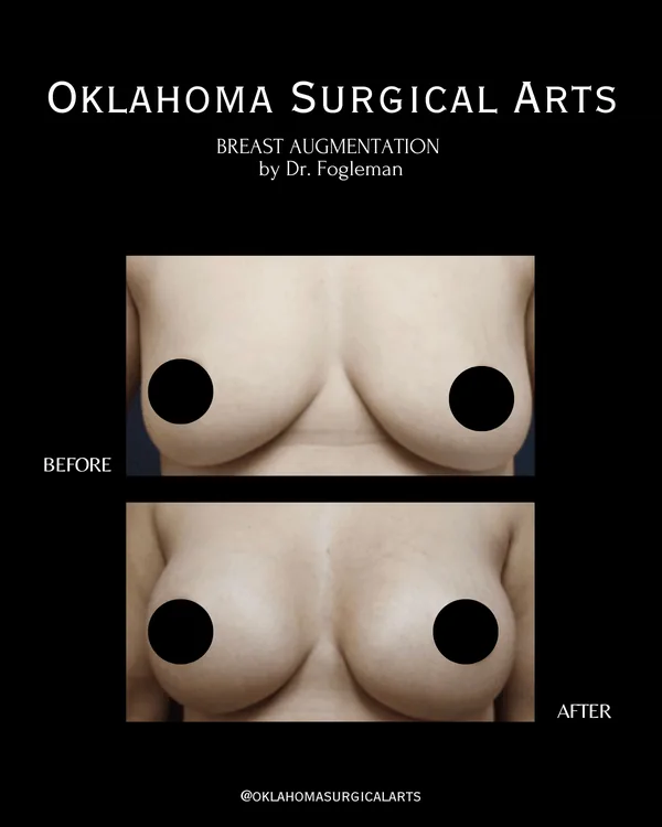 Before and after: breast augmentation, front view · by Dr. Fogleman · Oklahoma Surgical Arts