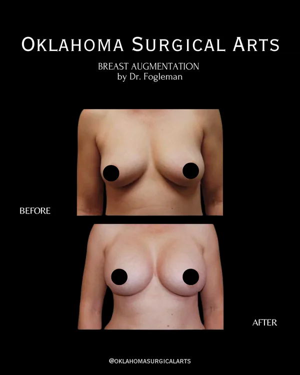 Before and after: breast augmentation, front view · by Dr. Fogleman · Oklahoma Surgical Arts