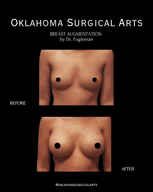 Before and after: breast augmentation, front view · by Dr. Fogleman · Oklahoma Surgical Arts