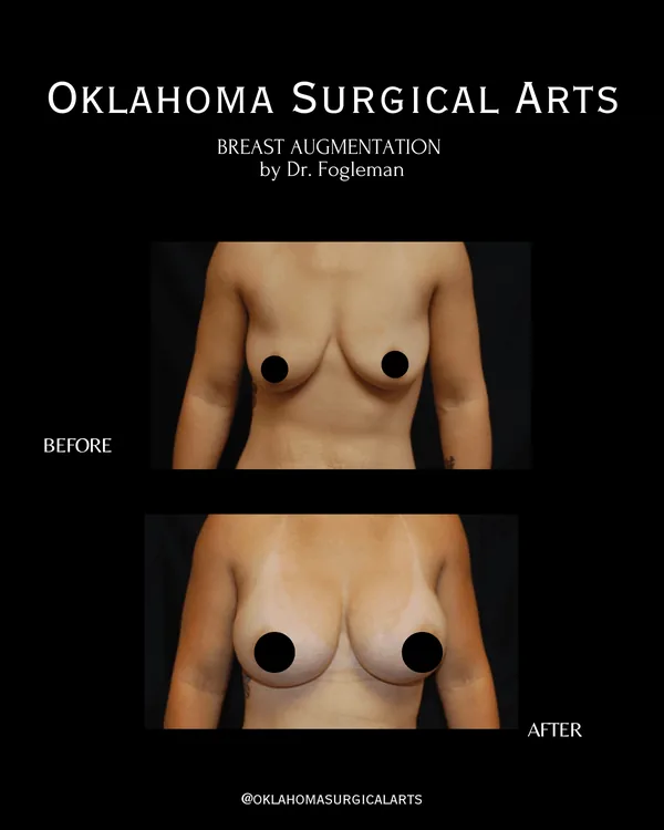 Before and after: breast augmentation, front view · by Dr. Fogleman · Oklahoma Surgical Arts
