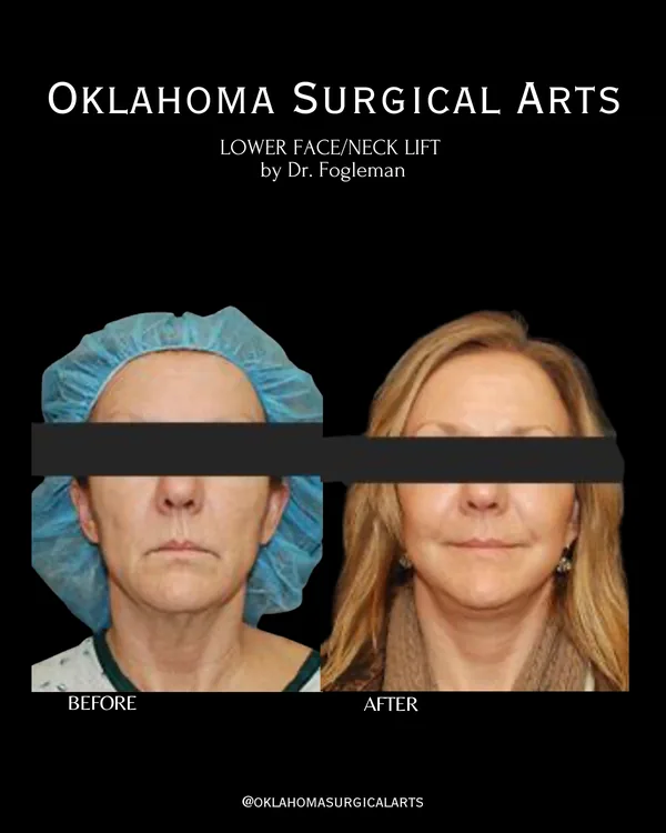 Before and after: lower face and neck lift, front view · by Dr. Fogleman · Oklahoma Surgical Arts