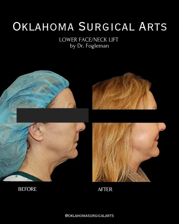 Before and after: lower face and neck lift, left profile · by Dr. Fogleman · Oklahoma Surgical Arts
