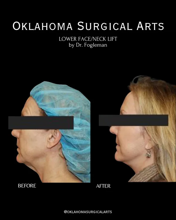 Before and after: lower face and neck lift, right profile · by Dr. Fogleman · Oklahoma Surgical Arts