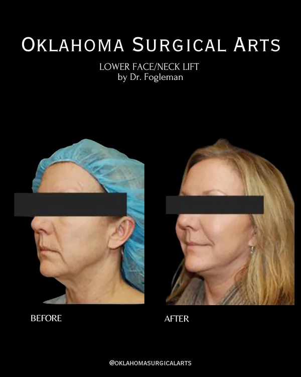 Before and after: lower face and neck lift, three-quarter view · by Dr. Fogleman · Oklahoma Surgical Arts
