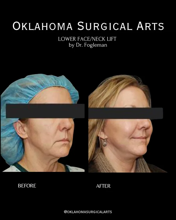 Before and after: lower face and neck lift, three-quarter view · by Dr. Fogleman · Oklahoma Surgical Arts