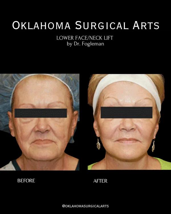 Before and after: lower face and neck lift, front view · by Dr. Fogleman · Oklahoma Surgical Arts