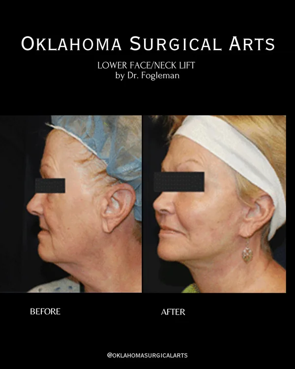 Before and after: lower face and neck lift, profile view · by Dr. Fogleman · Oklahoma Surgical Arts