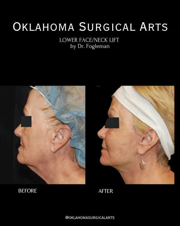 Before and after: lower face and neck lift, left profile · by Dr. Fogleman · Oklahoma Surgical Arts