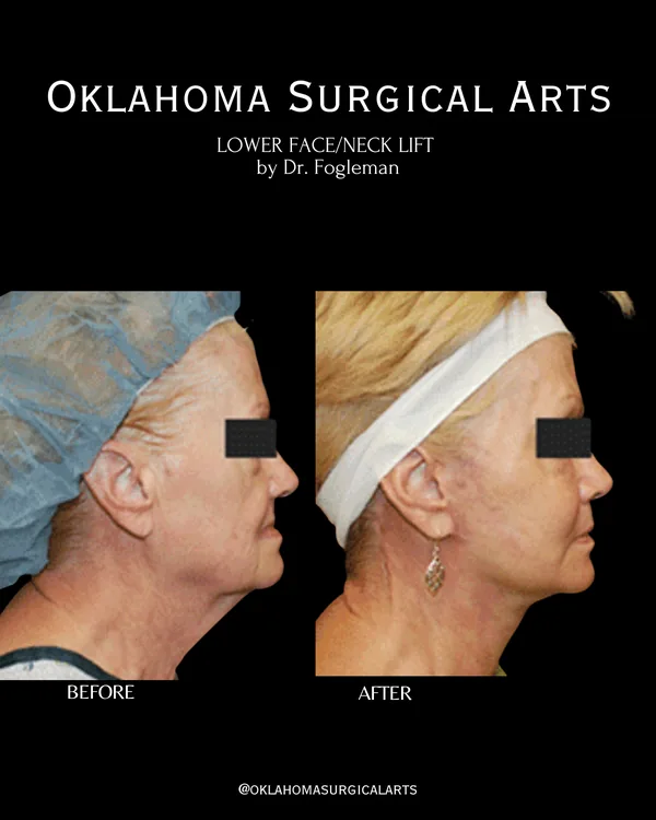 Before and after: lower face and neck lift, right profile · by Dr. Fogleman · Oklahoma Surgical Arts