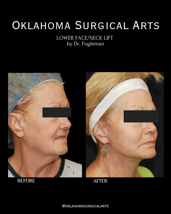 Before and after: lower face and neck lift, three-quarter view · by Dr. Fogleman · Oklahoma Surgical Arts