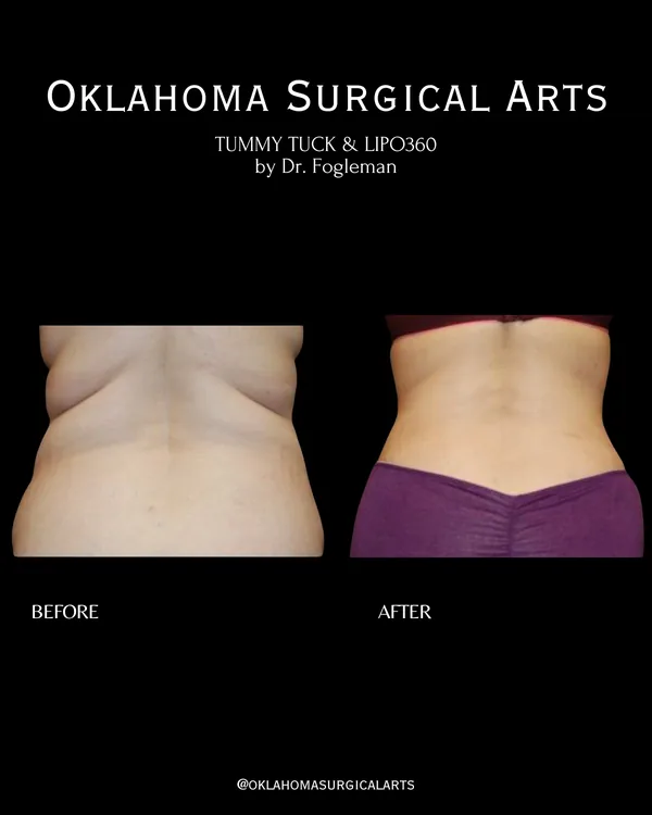 Before and after: tummy tuck with Lipo 360, back view · by Dr. Fogleman · Oklahoma Surgical Arts
