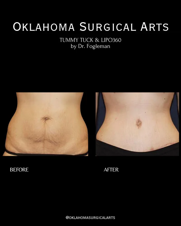 Before and after: tummy tuck with Lipo 360, front view · by Dr. Fogleman · Oklahoma Surgical Arts