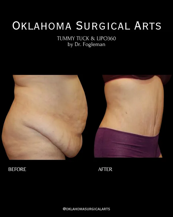 Before and after: tummy tuck with Lipo 360, side view · by Dr. Fogleman · Oklahoma Surgical Arts