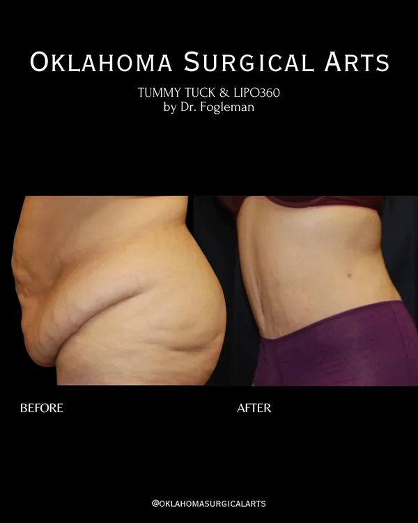 Before and after: tummy tuck with Lipo 360, side view · by Dr. Fogleman · Oklahoma Surgical Arts